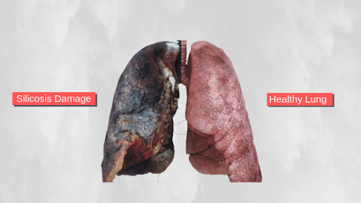 Healthy lung vs the lung affected by Silicosis