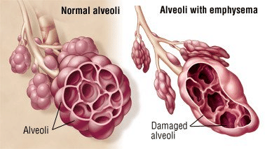 Alveoli with Emphysema