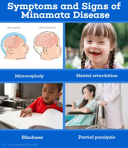 Symptoms of Minamata Disease