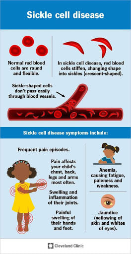Sickle Cell Disease