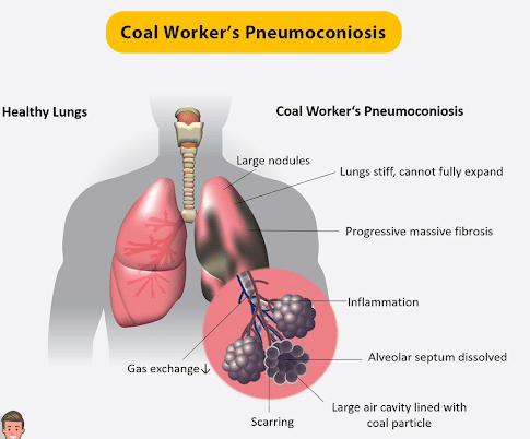 Pneumoconiosis