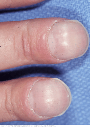 Clubbed Fingers