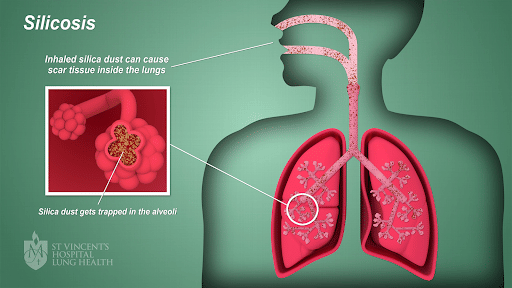 Silicosis