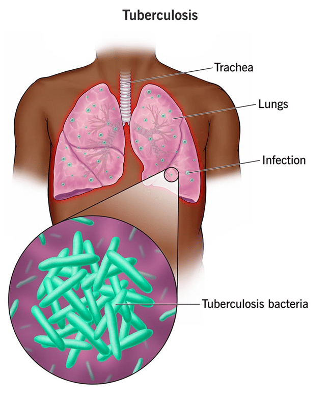 tuberculosis